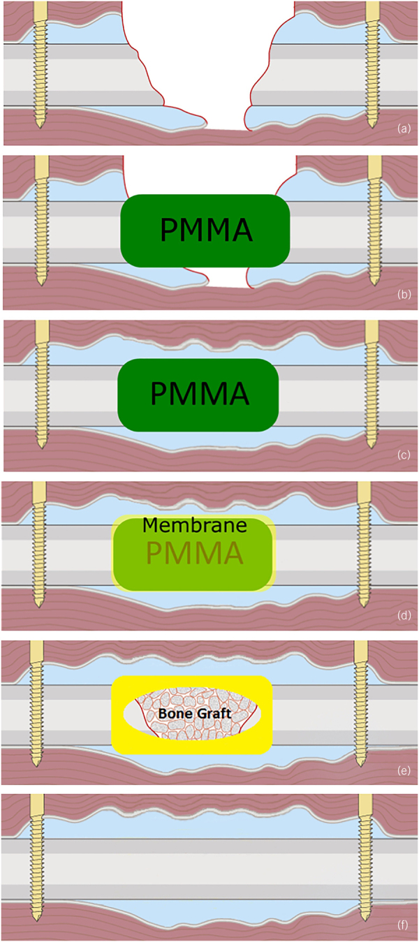 A review of the Masquelet technique in the treatment of lower limb critical-size bone defects.