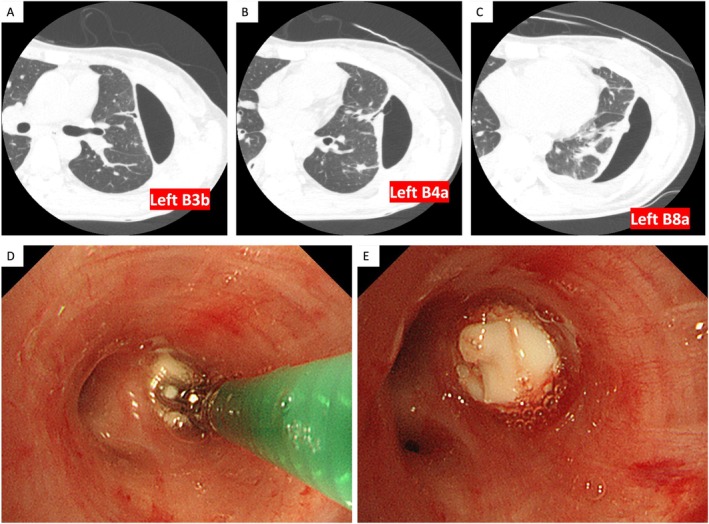 Intractable Pyopneumothorax due to Lemierre's Syndrome Treated With an Endobronchial Watanabe Spigot (EWS).