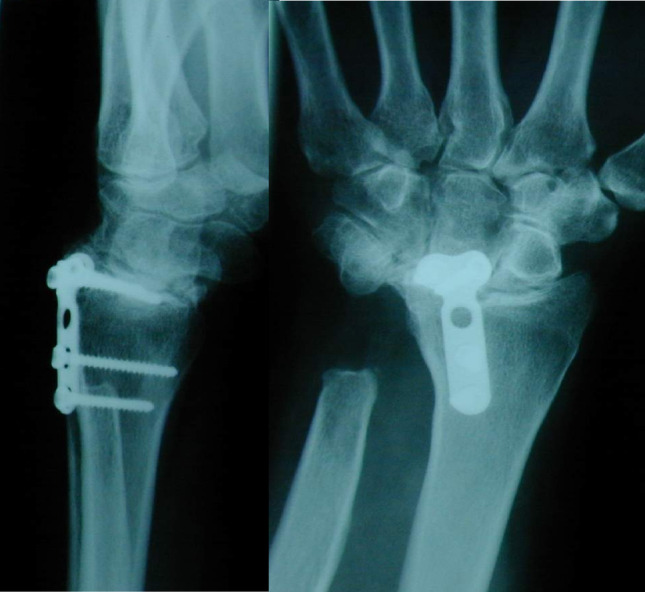 Total wrist arthroplasty revisited: survival, function, and patient-reported outcomes of BIAX and universal II prostheses over 15 years.