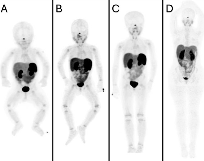 Physiological bio-distribution of 68Ga-DOTA-TATE in pediatric patients