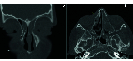 Heterotopic Ossification Originating from the Lacrimal Sac of a Child: A Case Report.