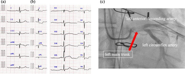 Progressive coronary stenosis detected by intraoperative TEE after acute type-A aortic dissection repair: a case report.