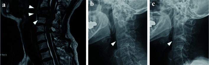 Breast Cancer With Airway Edema Caused by Metastatic Fracture of the Cervical Vertebra.