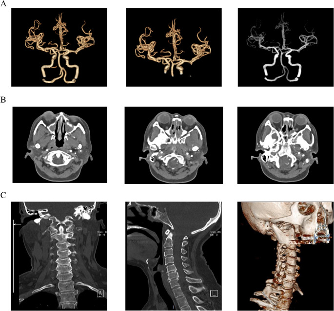 Dupilumab-induced Eosinophilic Granulomatosis with Polyangiitis Complicated by Peripheral Neuropathic Pain: a Case Report and Literature Review.