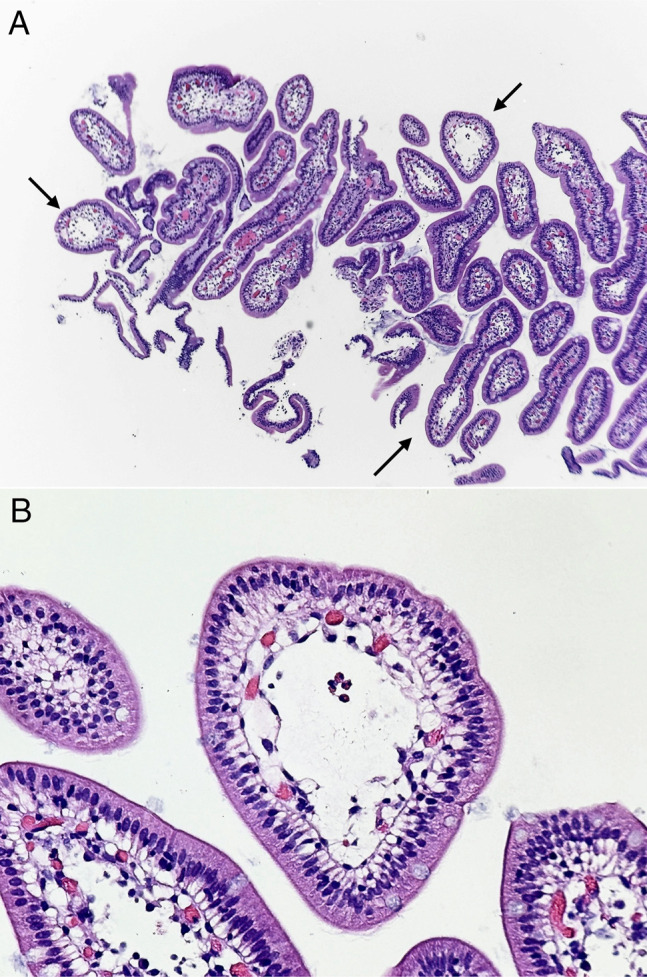 Elusive Edematous Primary Intestinal Lymphangiectasia in an Adult Patient Presenting With New Onset of Protein-Losing Enteropathy.