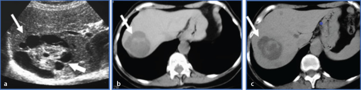 Tumor-like conditions that mimic liver tumors