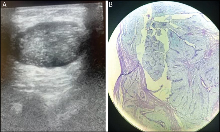 Assessing the Accuracy of Ultrasonography and Biopsy Necessity in the Management of Breast Lumps in Women Less than 40 Years.