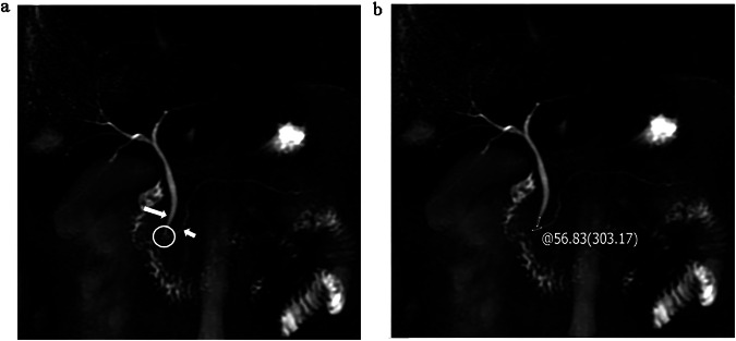 Individualized prediction of post-acute pancreatitis diabetes mellitus by combining lipid metabolism and anatomical features.