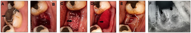 Effect of two deproteinized bone graft materials for socket preservation: a clinical and histological study.