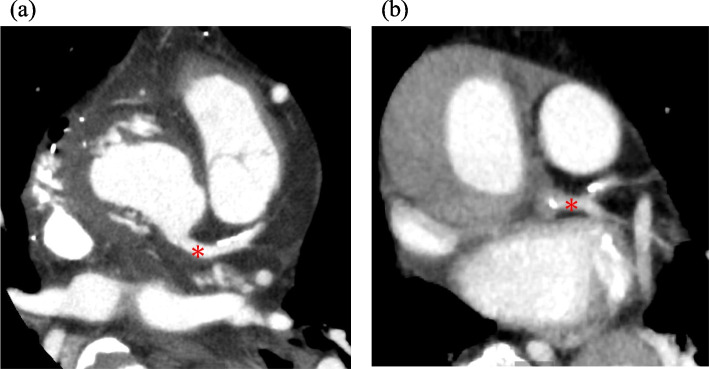 Progressive coronary stenosis detected by intraoperative TEE after acute type-A aortic dissection repair: a case report.