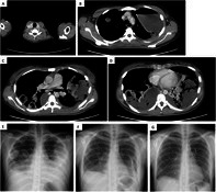 Intractable Pyopneumothorax due to Lemierre's Syndrome Treated With an Endobronchial Watanabe Spigot (EWS).