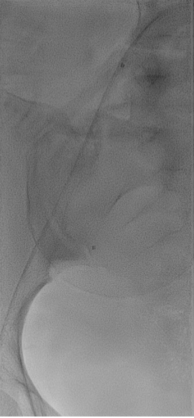 Prophylactic occlusion balloon in placenta abnormalities: What every interventional radiologist needs to know.