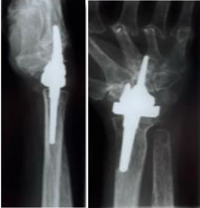 Total wrist arthroplasty revisited: survival, function, and patient-reported outcomes of BIAX and universal II prostheses over 15 years.
