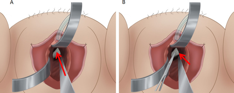 Application of an Intestinal Spatula in Optimizing a Sacrospinous Ligament Suspension.