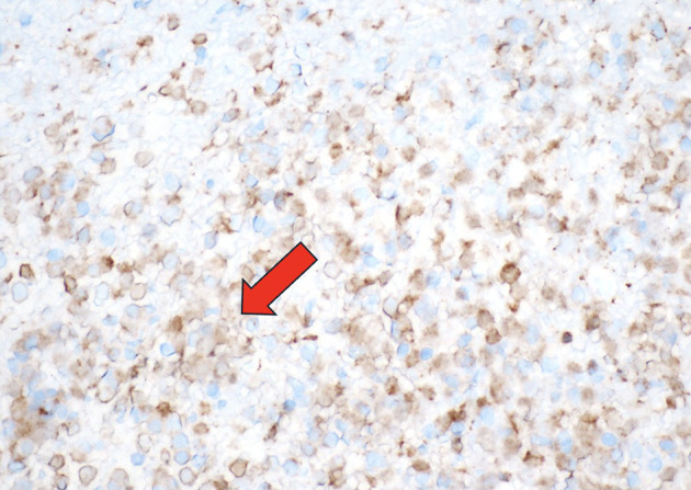 A Heart of Myeloid: Extramedullary Chronic Myelomonocytic Leukemia-2 Presenting as a Myeloid Sarcoma of the Pericardium Causing Recurrent Pericardial Effusions.