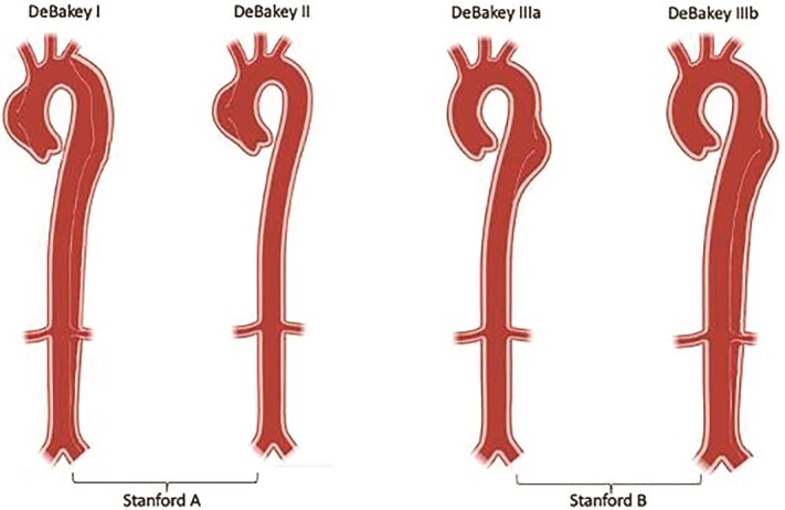 Aortic dissection presenting with Hemoptysis: a diagnostic challenge.
