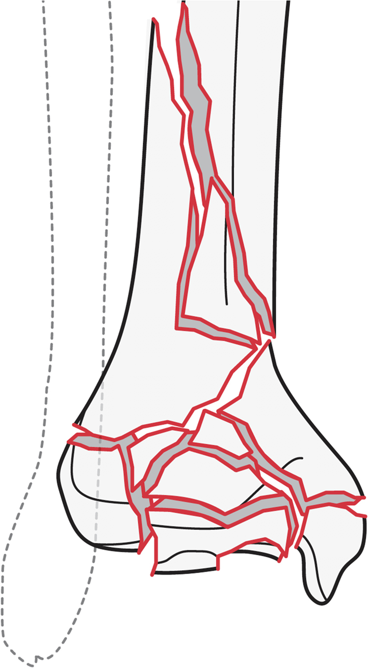What is a tibial pilon fracture and how should they be acutely managed? A survey of consultant British Orthopaedic Foot and Ankle Society members and non-members.