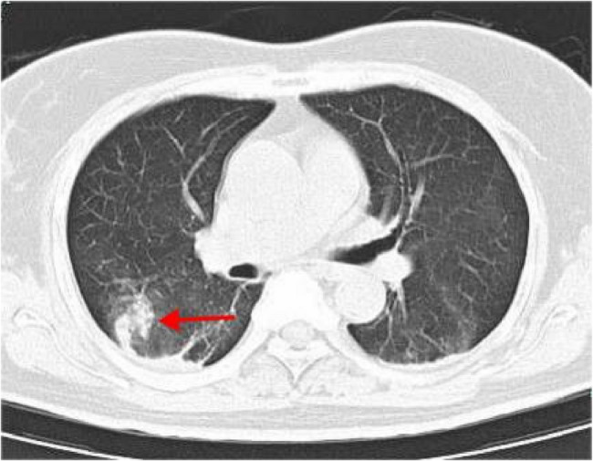 A "mass-forming" variant of ischemic colitis following COVID infection: a case report and review.