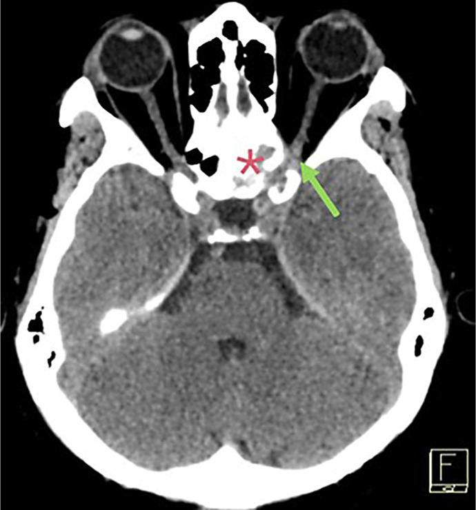 Rare Case of Metastatic Breast Cancer to the Sphenoid Sinus: Diagnosis and Treatment.