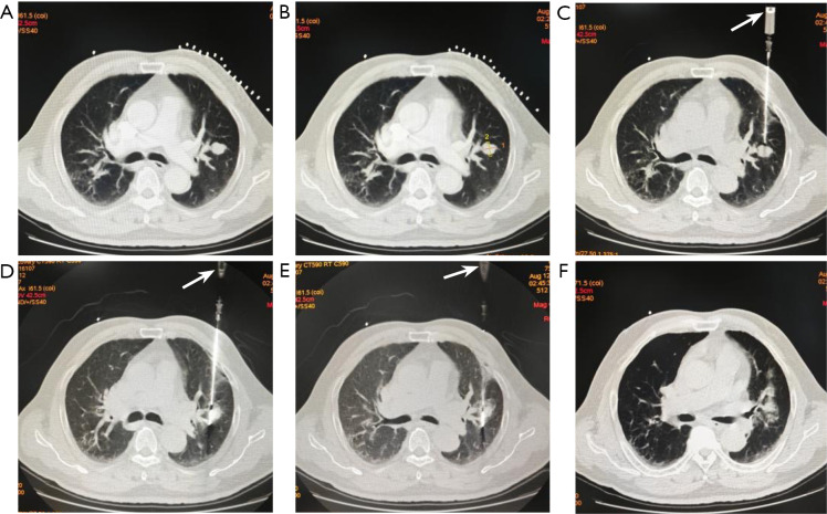 Synchronous percutaneous microwave ablation combined with percutaneous biopsy for highly suspected malignant pulmonary nodules: a retrospective study.