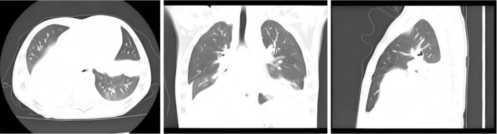 Analysis of factors influencing mortality in immunocompetent children with severe adenovirus pneumonia undergoing conventional treatments: a retrospective cohort study.