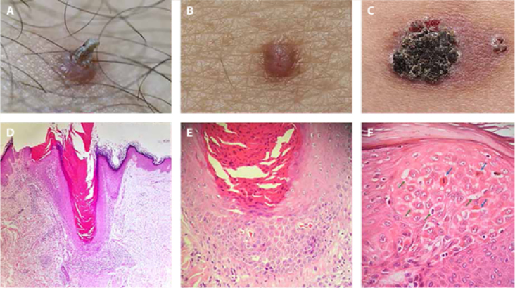 Clinical and Histopathological Insights into Acantholytic Dyskeratotic Acanthoma: A Case Series.