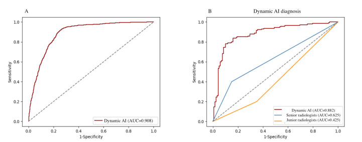 Optimizing Thyroid Nodule Management With Artificial Intelligence: Multicenter Retrospective Study on Reducing Unnecessary Fine Needle Aspirations.