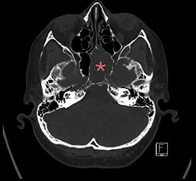Rare Case of Metastatic Breast Cancer to the Sphenoid Sinus: Diagnosis and Treatment.
