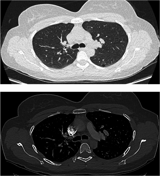 Pulmonary glue embolism after radiological embolization of pelvic varices: a case report.
