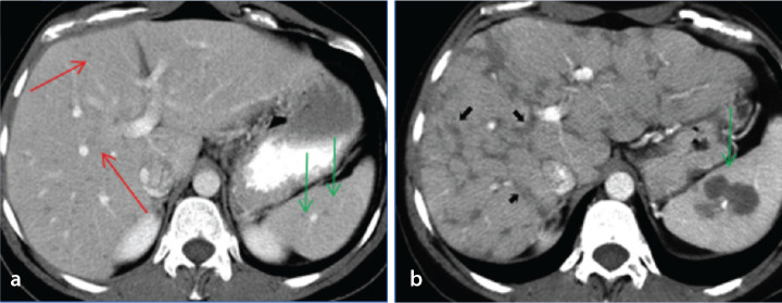 Tumor-like conditions that mimic liver tumors
