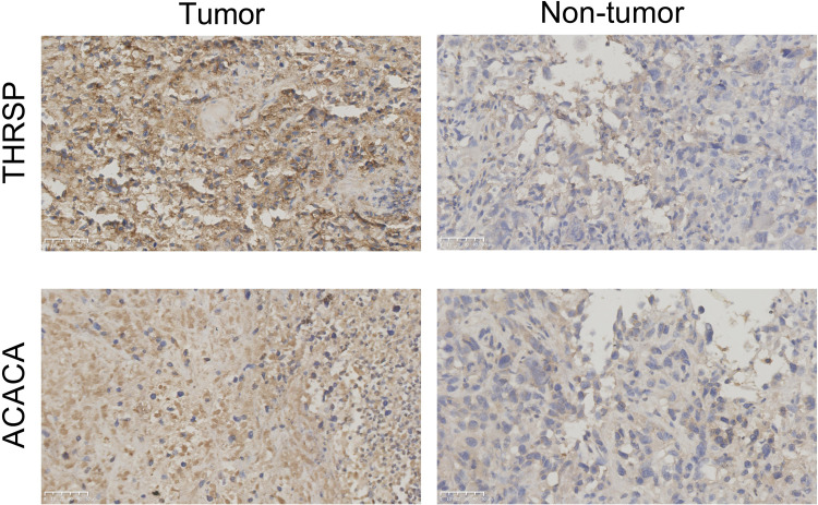 Construction of a Nomogram Model for Predicting Prognosis in Breast Cancer Patients Based on the Expression of THRSP and ACACA Proteins Tissues.