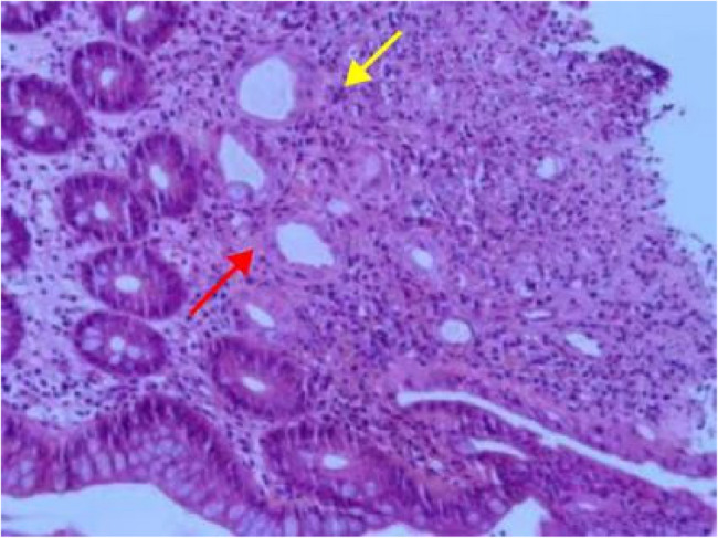 A "mass-forming" variant of ischemic colitis following COVID infection: a case report and review.