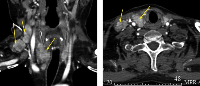 [A unique case of severe ACTH-dependent Cushing's syndrome due to ectopic corticotropin production by medullary thyroid carcinoma].