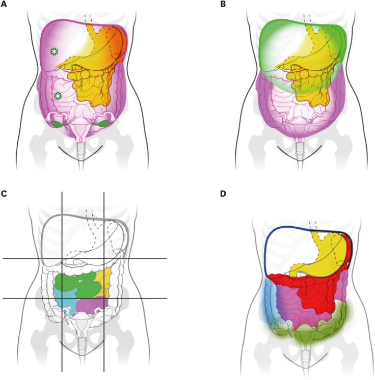 Peritoneal Oligometastasis in Gastric Cancer: Diagnostic Strategies, Patient Selection, and Emerging Therapeutic Approaches.