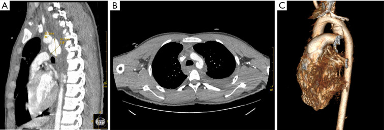 Endovascular treatment of a blunt thoracic aortic injury in adolescents: a case report.