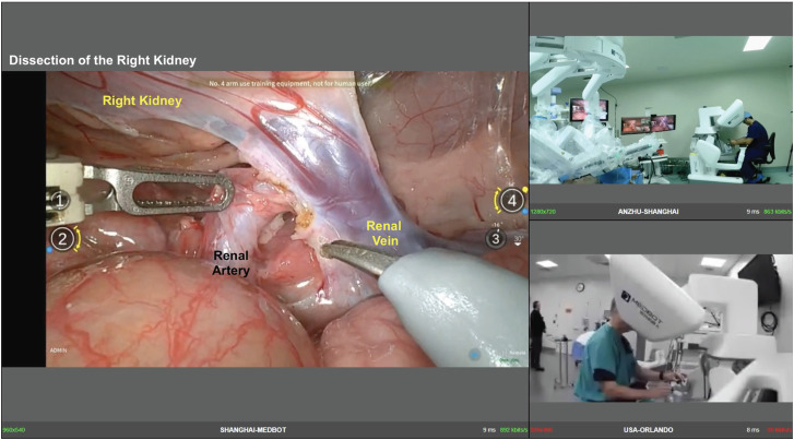 Exploring the Teleproctoring Potential of Telesurgery: The First Remote Procedures Performed Simultaneously Between Orlando and Shanghai.