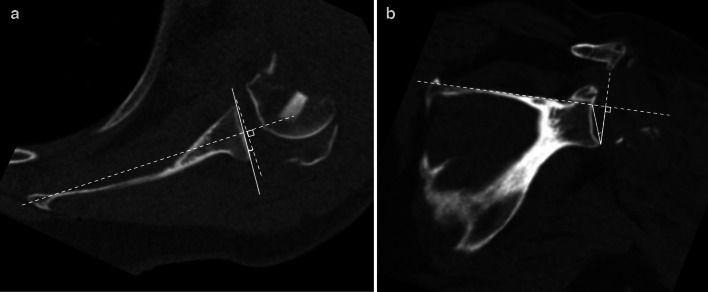 Glenoid morphology in patients undergoing reverse total shoulder arthroplasty due to fracture.