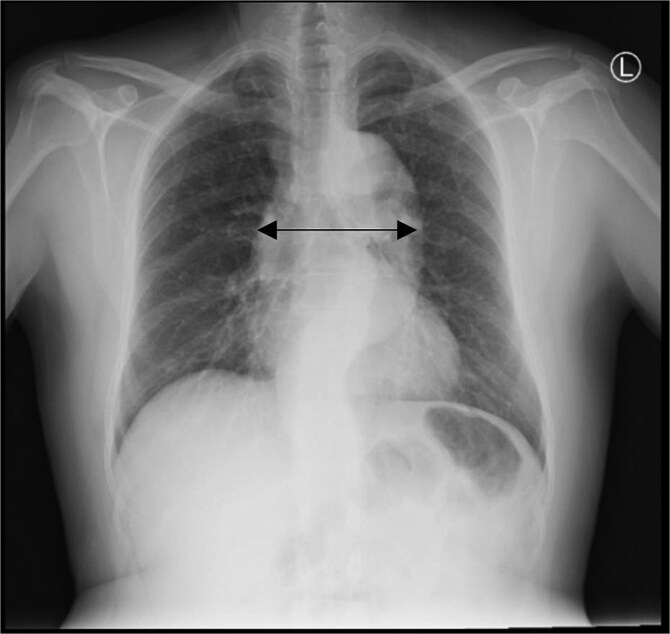 Aortic dissection presenting with Hemoptysis: a diagnostic challenge.