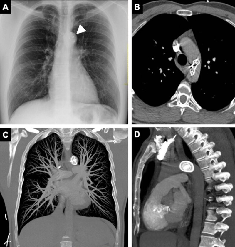 Migration of atrial septal occluder device to the thoracic aorta: case report.
