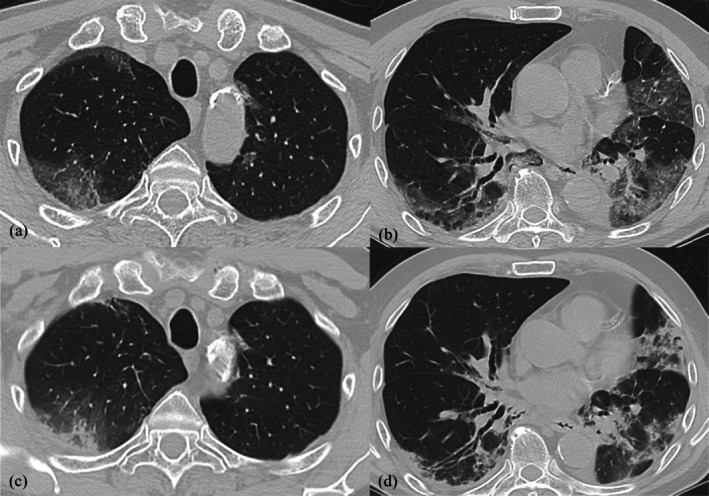 Regorafenib Induced Interstitial Pneumonia in a Patient With Refractory Rectal Cancer.