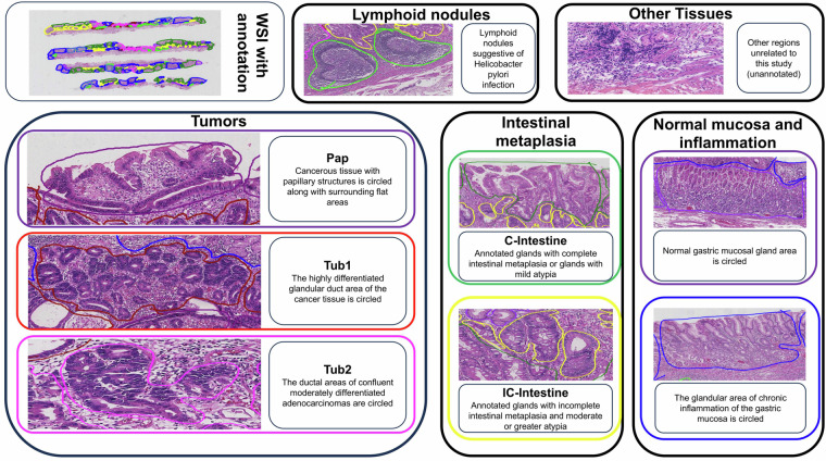 A fully annotated pathology slide dataset for early gastric cancer and precancerous lesions.
