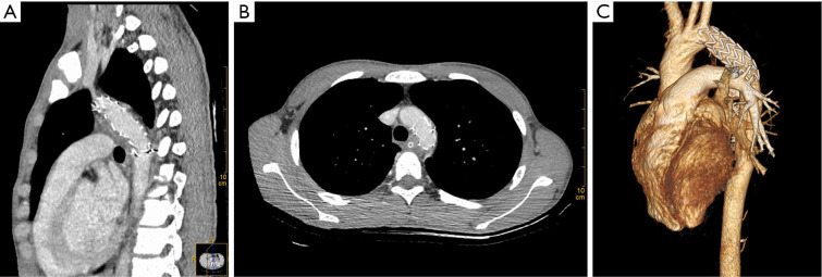 Endovascular treatment of a blunt thoracic aortic injury in adolescents: a case report.