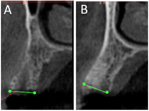 Effect of two deproteinized bone graft materials for socket preservation: a clinical and histological study.