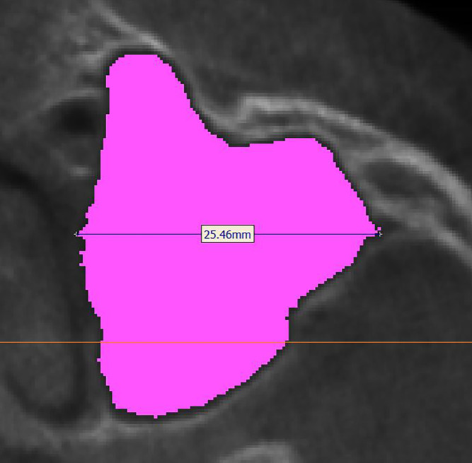 Evaluation of the relationship between sagittal skeletal discrepancies and maxillary sinus volume in adults using cone-beam computed tomography.