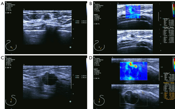Association between real-time shear wave elastography findings and HER-2 expression in breast cancer.