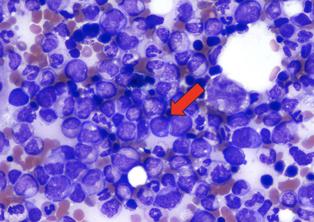 A Heart of Myeloid: Extramedullary Chronic Myelomonocytic Leukemia-2 Presenting as a Myeloid Sarcoma of the Pericardium Causing Recurrent Pericardial Effusions.