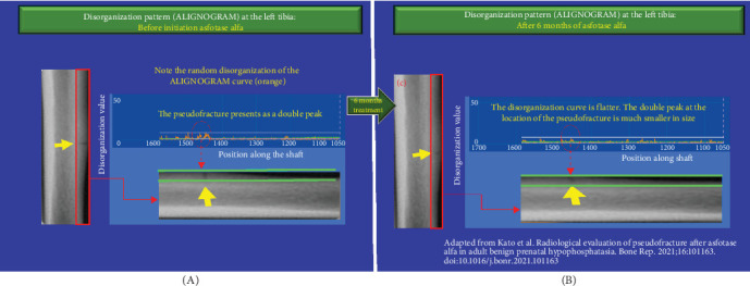 Improvements in Bone Disorganization and Pseudo-Fracture Healing in Hypophosphatasia Following Asfotase Alfa Therapy May Be Detectable by the ALIGNOGRAM Before Changes in Bone Radiography or Scintigraphy.