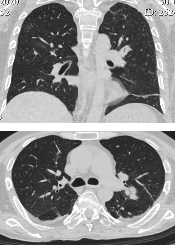 [A unique case of severe ACTH-dependent Cushing's syndrome due to ectopic corticotropin production by medullary thyroid carcinoma].