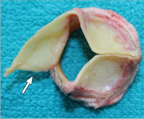 Early Structural Valve Deterioration and Cusp Tear Leading to Acute Heart Failure in a Second-Generation Trifecta Glide Technology Heart Valve.