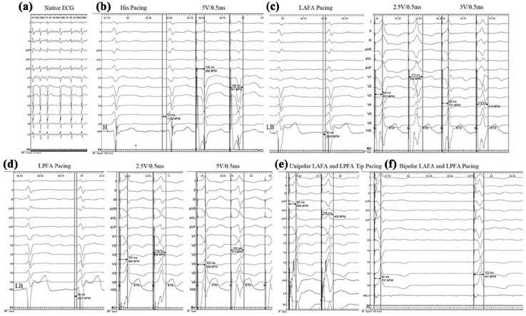 Benefits of Simultaneous Pacing Left Anterior/Posterior Fascicular Areas Combined with Atrioventricular Node Ablation in a Persistent Atrial Fibrillation Patient with Heart Failure: A Case Report.